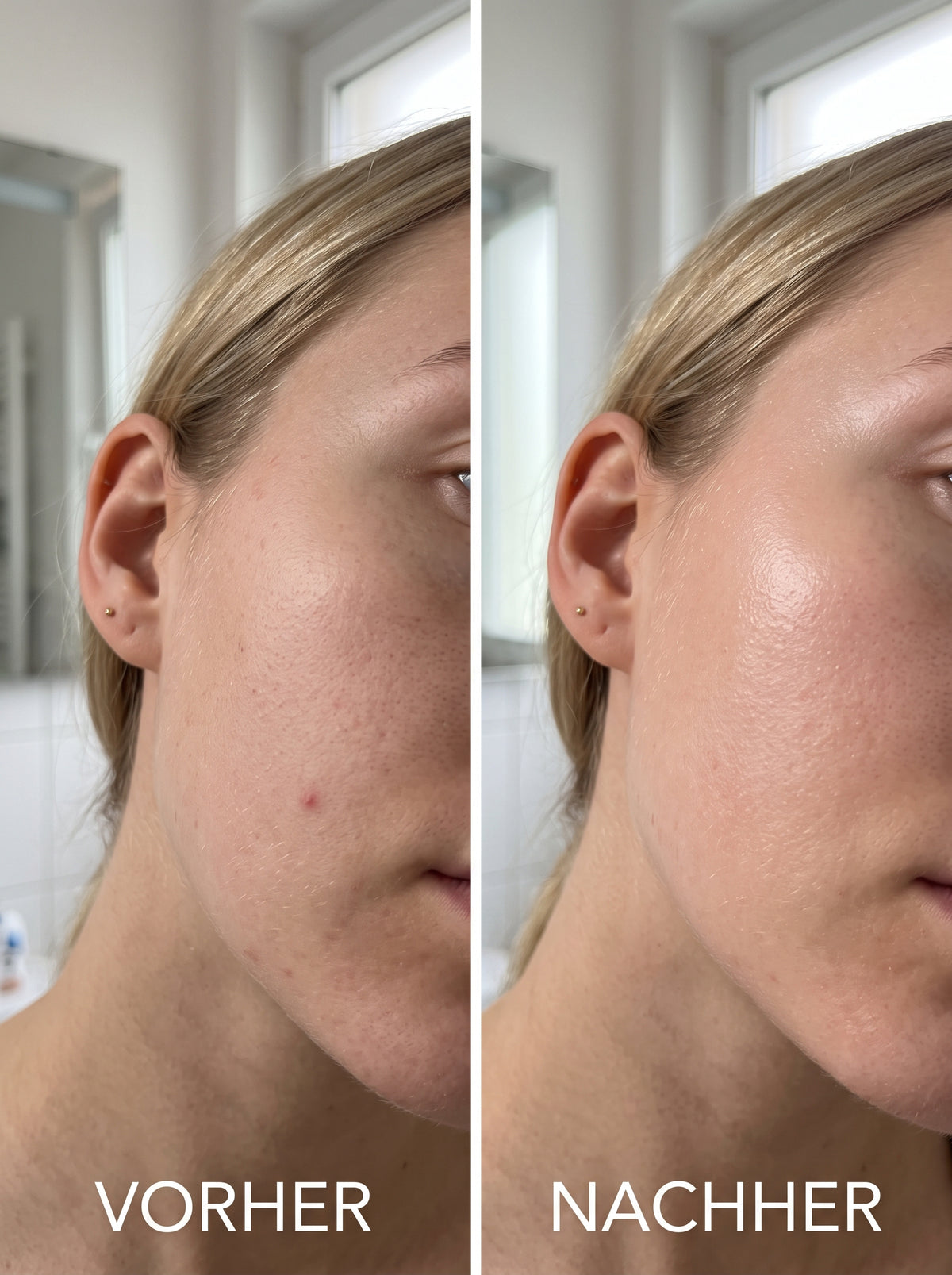 Vorher-Nachher-Nahaufnahme der Augen- und Wangenpartie. Links ein leichter Kissenabdruck, rechts glatte Haut ohne Abdrücke.